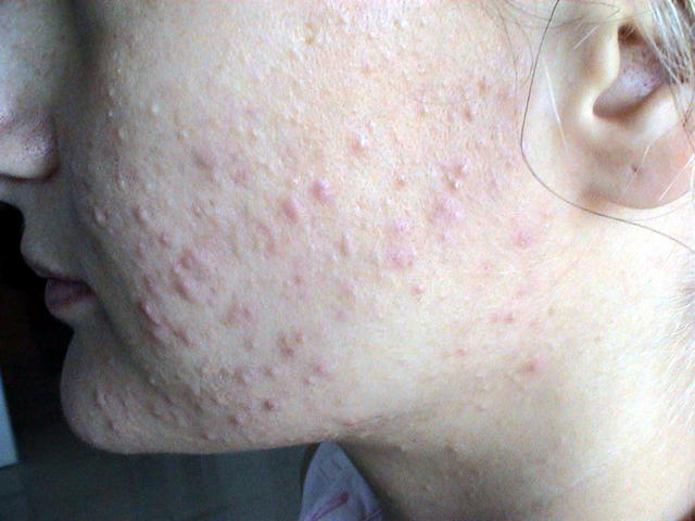 DISEASES OF THE SEBACEOUS GLANDS - Acne, Comedonal DISEASES OF THE SEBACEOUS GLANDS - Acne, Comedonal