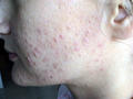 DISEASES OF THE SEBACEOUS GLANDS - Acne, Comedonal