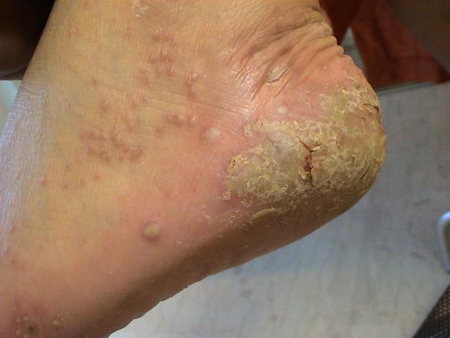 PSORIASIS - Pustular psoriasis