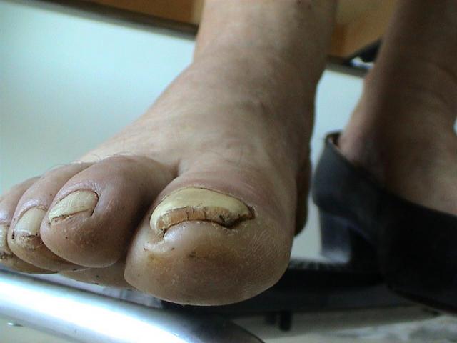 NAIL DISEASES - Onychomycosis