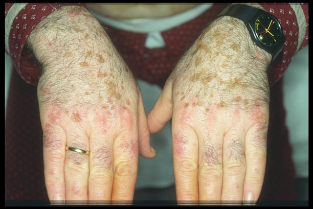 PIGMENTATION DISORDERS - Vitiligo