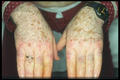 PIGMENTATION DISORDERS - Vitiligo