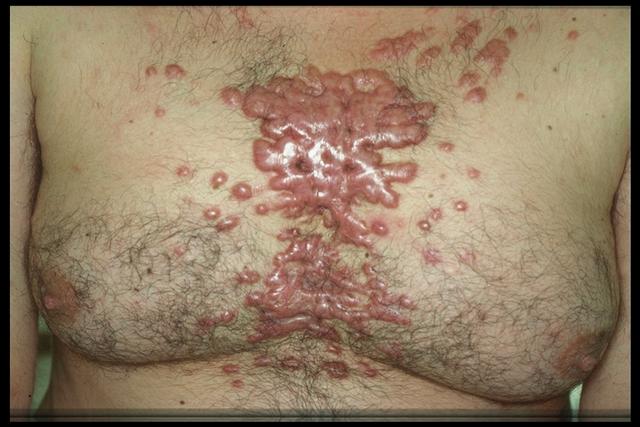 SOFT TISSUE TUMORS - Cheloids SOFT TISSUE TUMORS - Cheloids