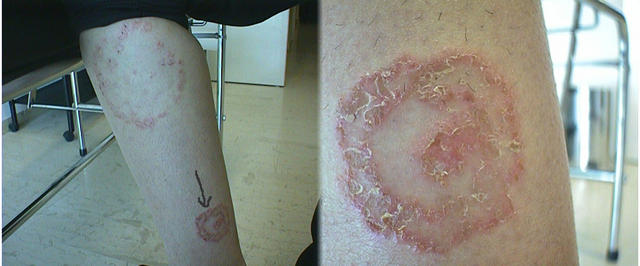 SUPERFICIAL FUNGAL INFECTIONS - Tinea corporis due to trichophyton SUPERFICIAL FUNGAL INFECTIONS - Tinea corporis due to trichophyton