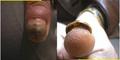 NAIL DISEASES - Onychomycosis due to Candida albicans infection