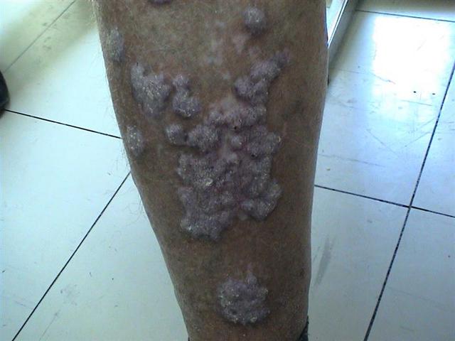 hypertrophic lichen planus