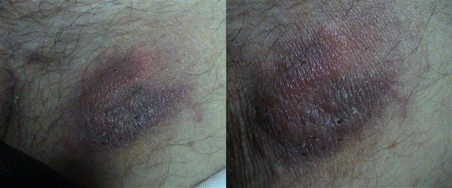 VARIOUS or of UNKNOWN ETIOLOGY DISEASES - Pseudolymphoma