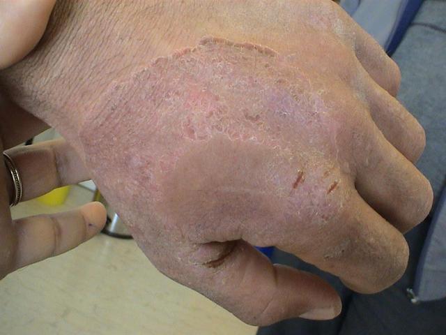 SUPERFICIAL FUNGAL INFECTIONS - Tinea manuum due to trichophyton picture