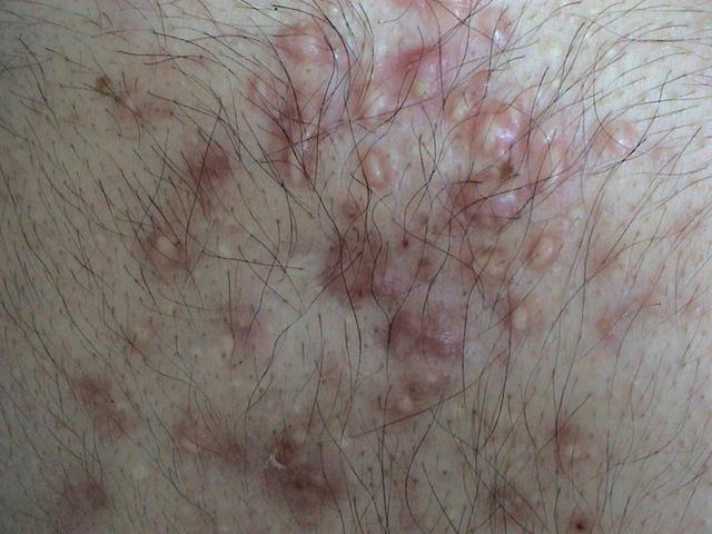 DISEASES OF THE SEBACEOUS GLANDS - Acne - Cystic lesions of the thorax DISEASES OF THE SEBACEOUS GLANDS - Acne - Cystic lesions of the thorax