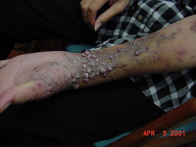 SKIN LESIONS IN HIV-AIDS PATIENTS - HIV Kaposi