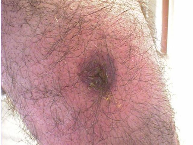 PARASITOSES, BITES - Tick bite PARASITOSES, BITES - Tick bite