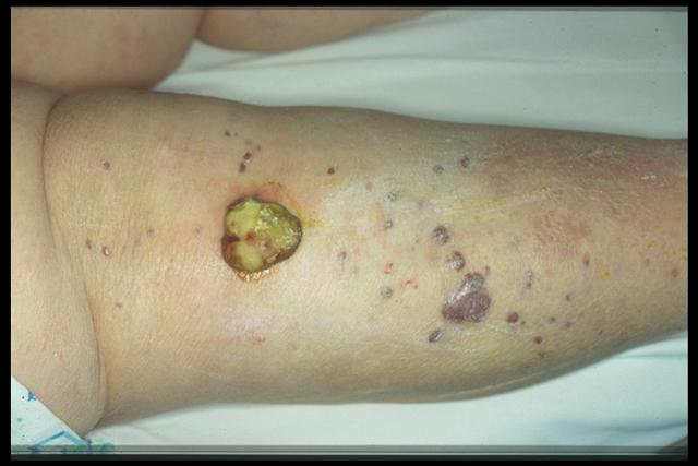 SOFT TISSUE TUMORS - Kaposi sarcoma SOFT TISSUE TUMORS - Kaposi sarcoma