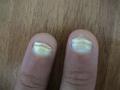 NAIL DISEASES - Leukonychia, congenital