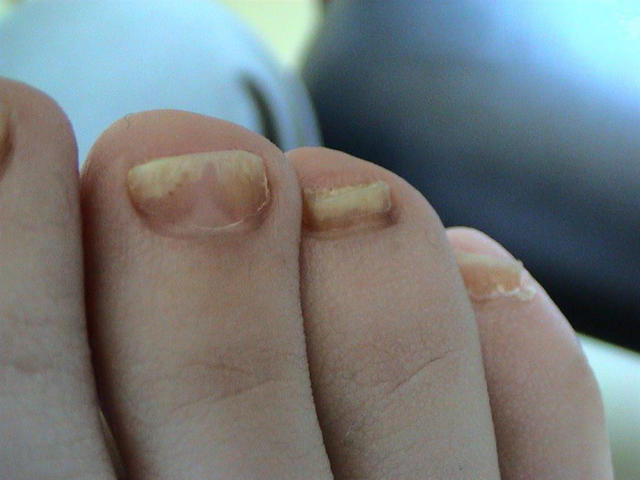 Psoriasis Psoriatic Nails Picture Hellenic Dermatological Atlas