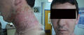 DERMATITIS - EKZEMA - Allergic Contact Dermatitis