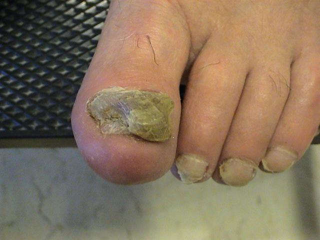 NAIL DISEASES - Onychomycosis