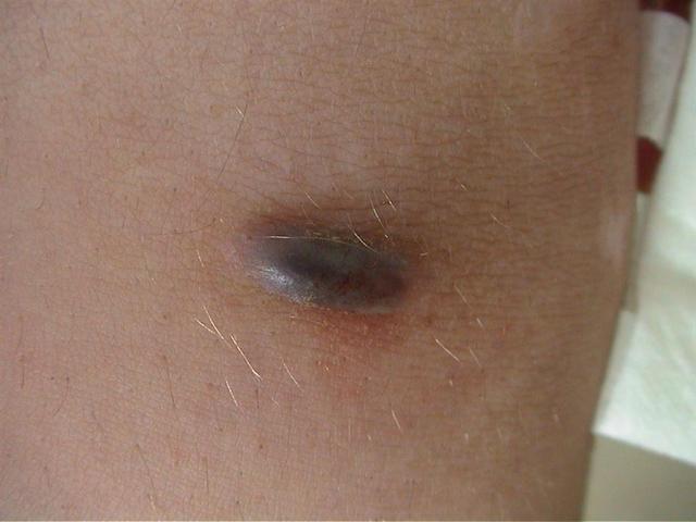 BENIGN SKIN LESIONS, NEVI, CYSTS - Dermatofibroma BENIGN SKIN LESIONS, NEVI, CYSTS - Dermatofibroma
