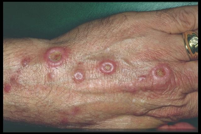 FACTICIAL LESIONS - Chemical burn from sulphuric acid
