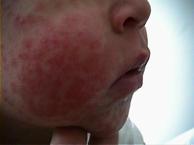 DRUG ERUPTIONS - Amoxicillin/clavoulanic acid induced drug eruption DRUG ERUPTIONS - Amoxicillin/clavoulanic acid induced drug eruption