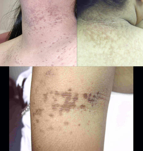 KERATINISATION DISORDERS - Confluent and reticulated papillomatosis of Gougerot-Gardeaux KERATINISATION DISORDERS - Confluent and reticulated papillomatosis of Gougerot-Gardeaux