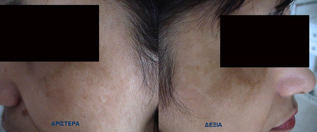 PIGMENTATION DISORDERS - Melasma