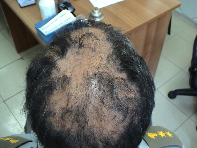 LICHEN - Lichen planopilaris of the scalp LICHEN - Lichen planopilaris of the scalp
