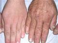 GENODERMATOSES - Acrokeratosis verruciformis of Hopf