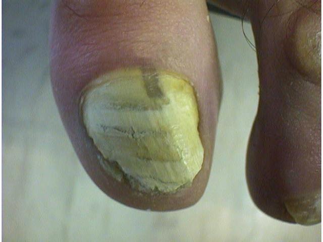 SUPERFICIAL FUNGAL INFECTIONS - Superficial white onychomycosis