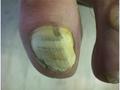 SUPERFICIAL FUNGAL INFECTIONS - Superficial white onychomycosis