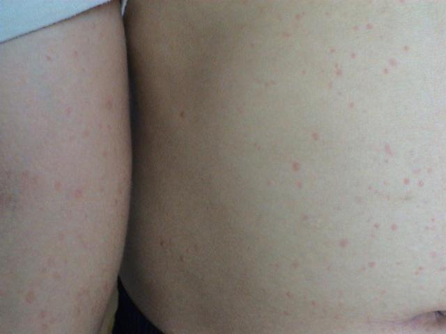 URTICARIA - Cholinergic urticaria