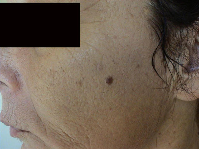 CONNECTIVE TISSUE DISORDERS - Photoaging CONNECTIVE TISSUE DISORDERS - Photoaging