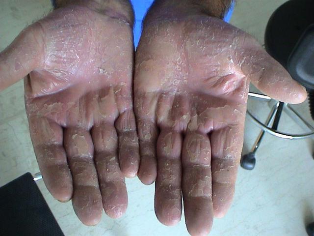 PSORIASIS - Psoriasis of the palms and soles (Keratoderma)