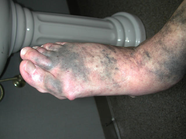 ΦΑΡΜΑΚΕΥΤΙΚΑ ΕΞΑΝΘΗΜΑΤΑ - Μελάγχρωση σε πόδια από λήψη Τετρακυκλίνης