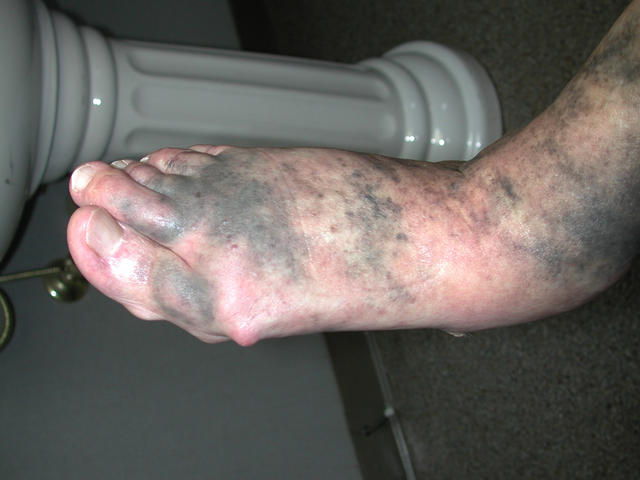 DRUG ERUPTIONS - Pigmentation of the feet due to tetracycline DRUG ERUPTIONS - Pigmentation of the feet due to tetracycline