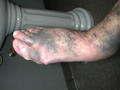 DRUG ERUPTIONS - Pigmentation of the feet due to tetracycline