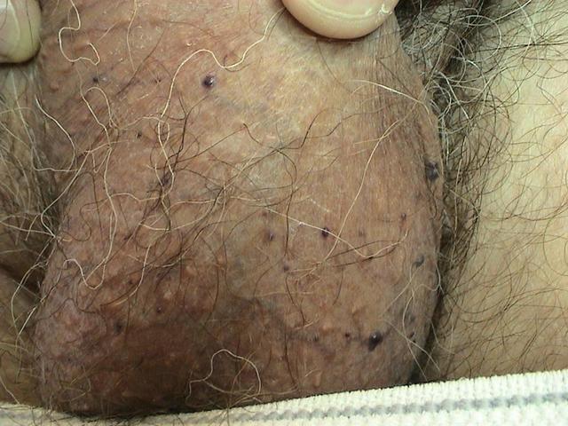 DISEASE OF THE BLOOD AND THE VESSELS – PURPURAS - Angiokeratomas of the scrotum