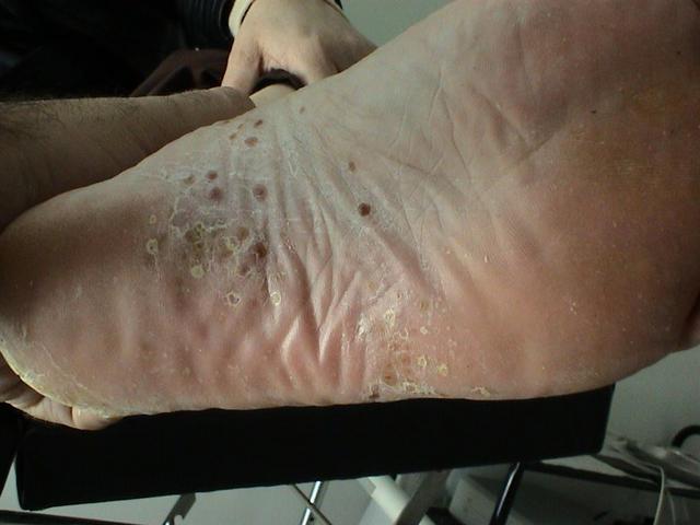 PSORIASIS - Psoriasis PSORIASIS - Psoriasis