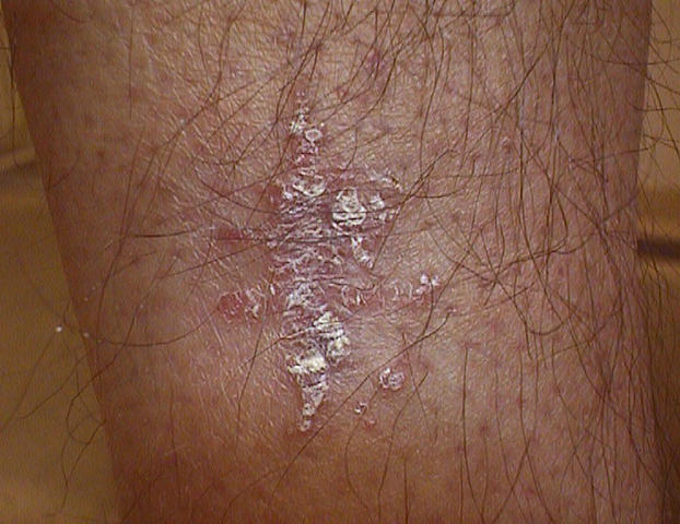 PSORIASIS - Psoriasis, Keobner phenomenon PSORIASIS - Psoriasis, Keobner phenomenon