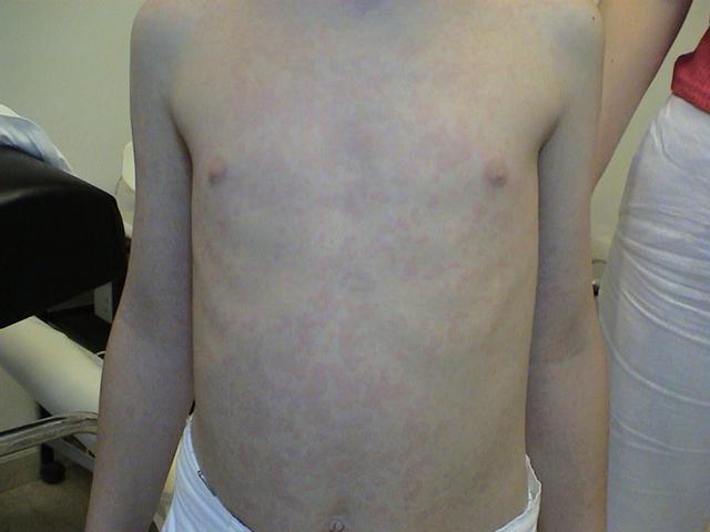 VIRAL INFECTIONS - Toxic erythema VIRAL INFECTIONS - Toxic erythema