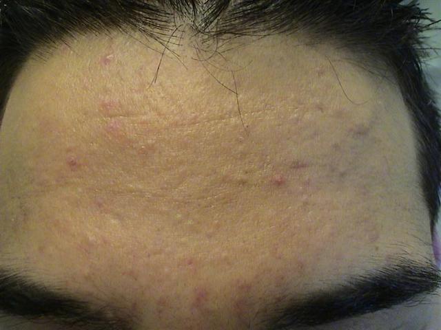 DISEASES OF THE SEBACEOUS GLANDS - Acne vulgaris DISEASES OF THE SEBACEOUS GLANDS - Acne vulgaris