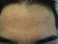 DISEASES OF THE SEBACEOUS GLANDS - Acne vulgaris