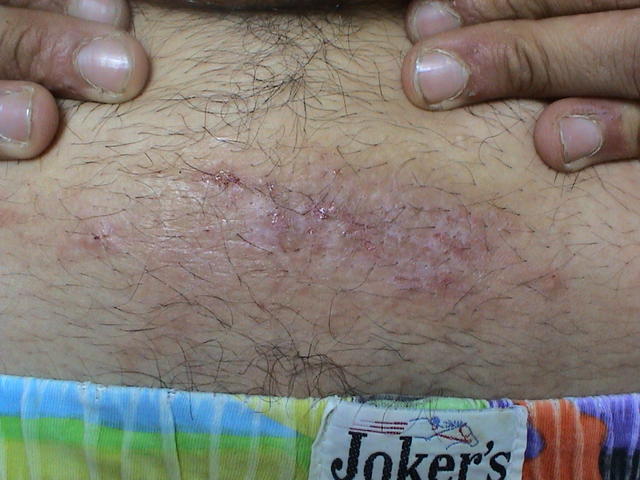 DERMATITIS - EKZEMA - Allergic Contact Dermatitis DERMATITIS - EKZEMA - Allergic Contact Dermatitis