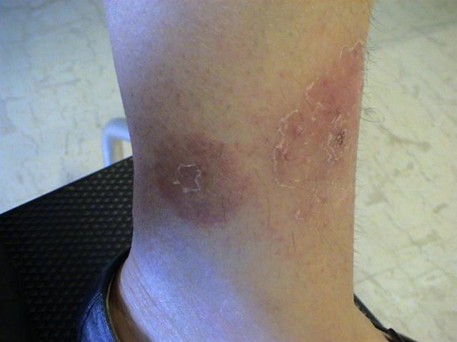 DISEASE OF THE BLOOD AND THE VESSELS – PURPURAS - Erythema nodosum