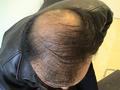 HAIR DISEASES - Androgenetic alopecia