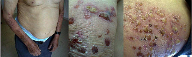 BULLOUS DISEASES - Bullous pemphigoid BULLOUS DISEASES - Bullous pemphigoid