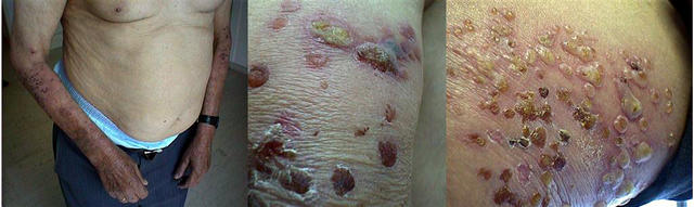 BULLOUS DISEASES - Bullous pemphigoid