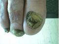 NAIL DISEASES - Onychomycosis