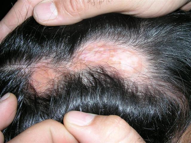 HAIR DISEASES - Alopecia cicatricial HAIR DISEASES - Alopecia cicatricial