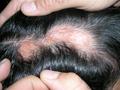 HAIR DISEASES - Alopecia cicatricial