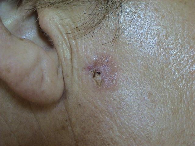 CONNECTIVE TISSUE DISORDERS - Discoid lupus erythematosus CONNECTIVE TISSUE DISORDERS - Discoid lupus erythematosus